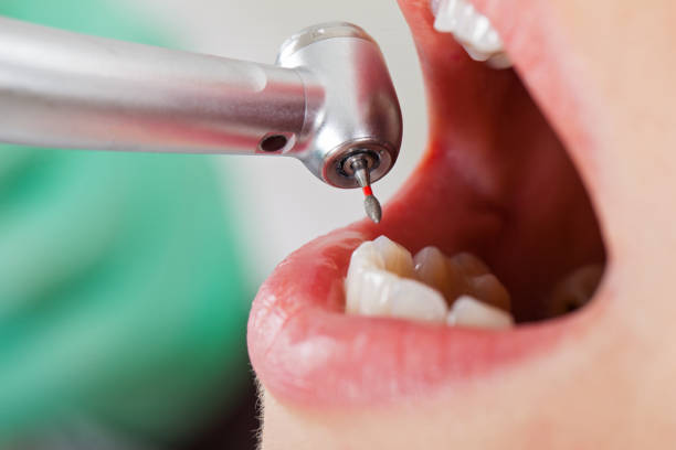 Best Broken or Chipped Tooth Repair in Mdleton, ID
